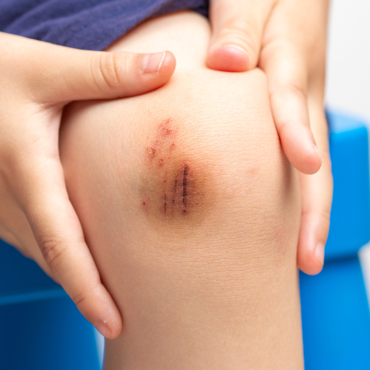 HEALING SAVLE - CUTS, BURNS & BRUISES